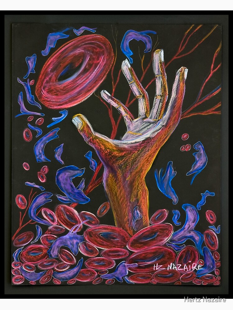 Sickle Cell Pain Awareness - HOPE by Hertz Nazaire